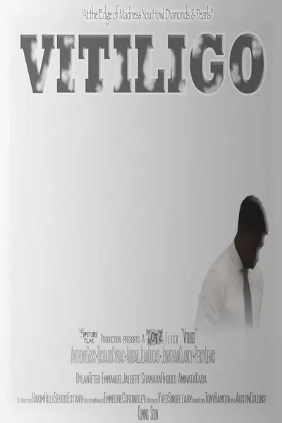 Vitiligo