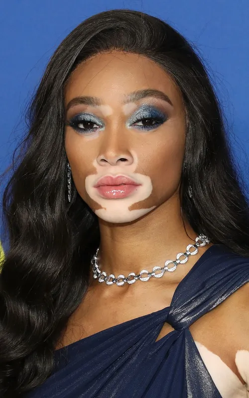 Winnie Harlow