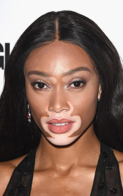 Winnie Harlow