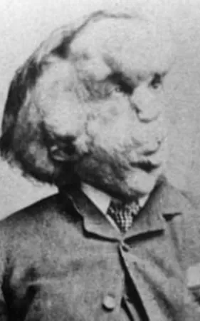 Joseph Merrick